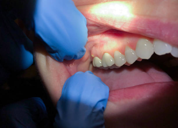 Best Lost Filling or Crown Replacement in Linda, CA
